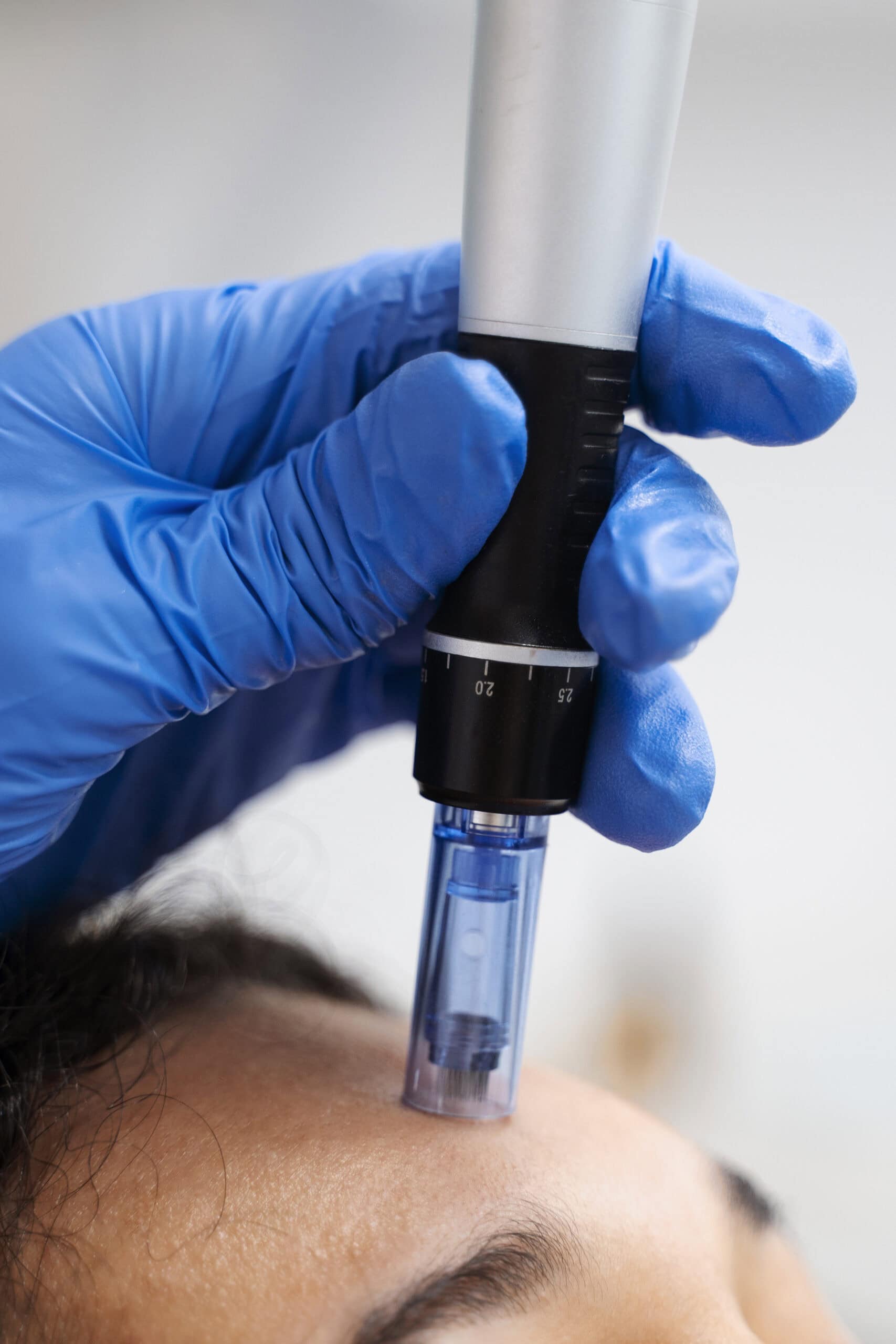 patient undergoing microneedling procedure 2